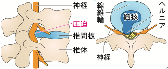 椎間板画像　ヘルニア